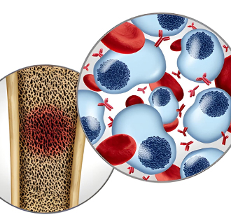 Diagram showing multiple myeloma inside bone marrow.